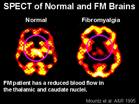 Bianca Enricone - Fibromialgia: dor crônica sem causa aparente- Detox Kriyá - Foto Divulgação Bianca Enricone - Fibromialgia: dor crônica sem causa aparente- Detox Kriyá - Foto Divulgação