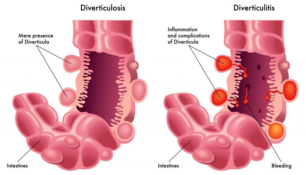 Bianca Enricone -Diverticulite e Diverticulose, Diferenças, Causas e Sintomas- Detox Kriyá - Foto Divulgação